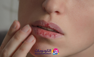 جفاف الفم واللسان