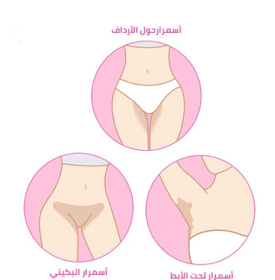اسمرار المنطقة الحساسة